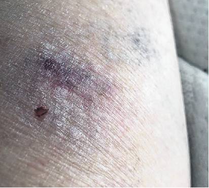 Bruising and marks on the calf of Susan Sloan’s leg after the dog attack. Photo: Supplied