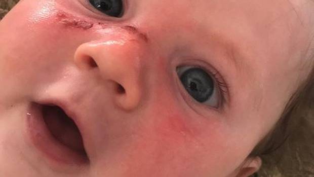 Noah - four months old - suffers horrific blister burns after Cancer Society 50 SPF sunblock...