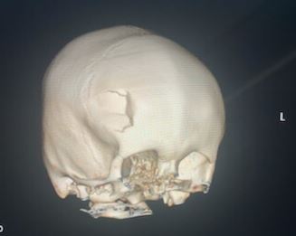 A scan revealed a depressed skull fracture. Image: Supplied