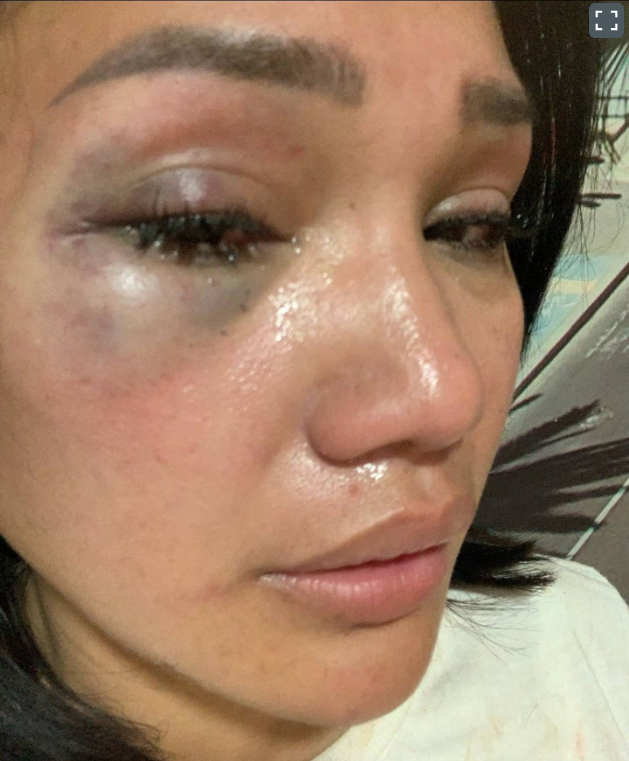 Bruising to Desta's face and a black eye after an alleged incident with Kelleher in Barcelona in...