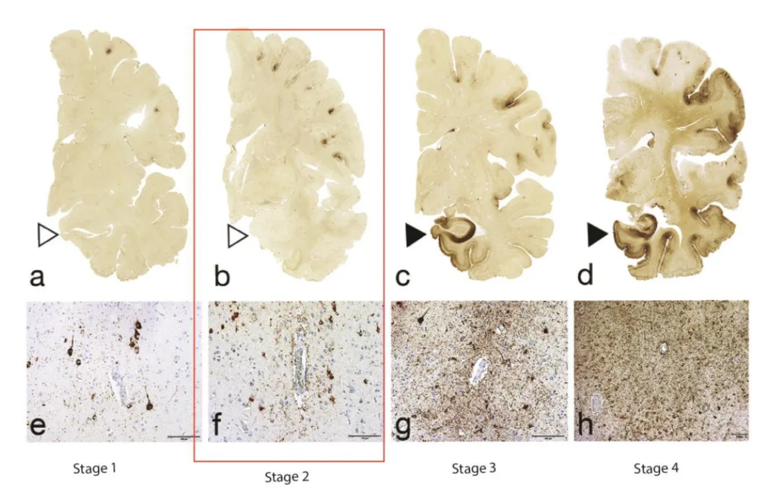 Scanned images of a brain affected by various stages of Chronic Traumatic Encepahlopathy (CTE) -...