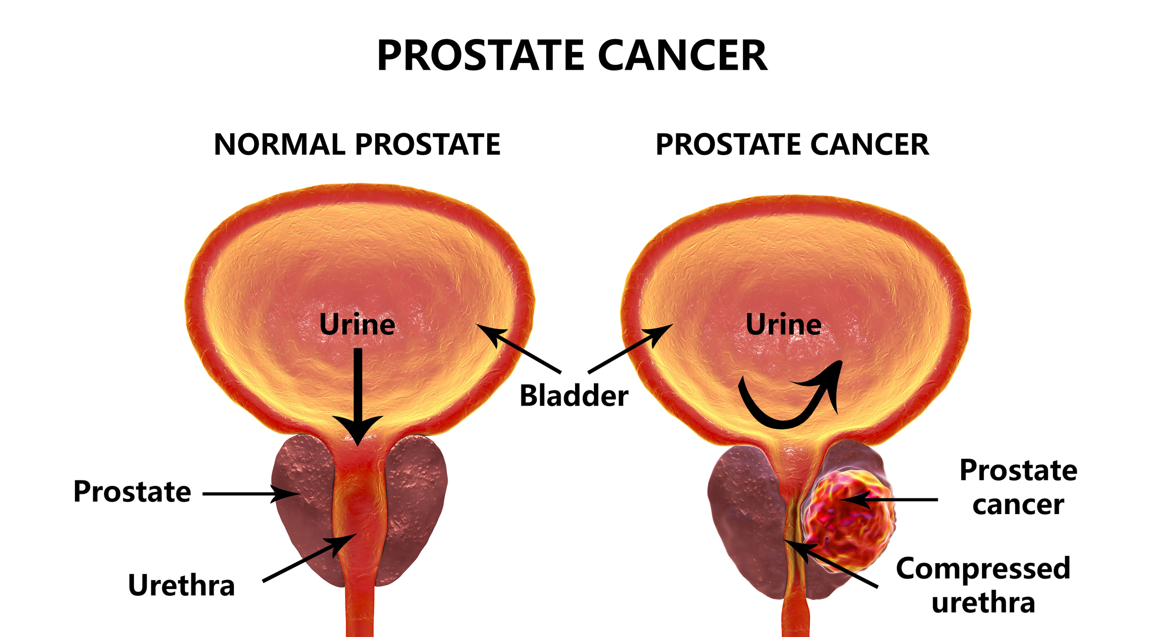 Prostate cancer explained. GRAPHIC: GETTY IMAGES