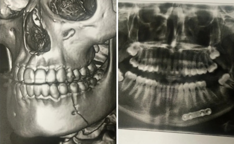 X-rays posted on social media by the teenager's mother. Photo: Supplied