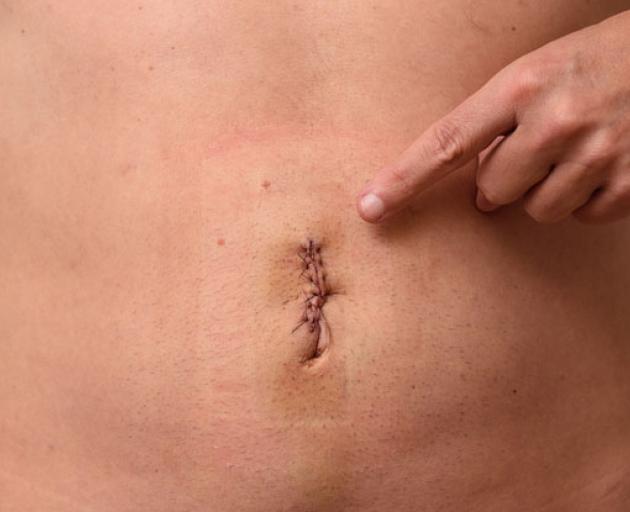 belly button surgery photos