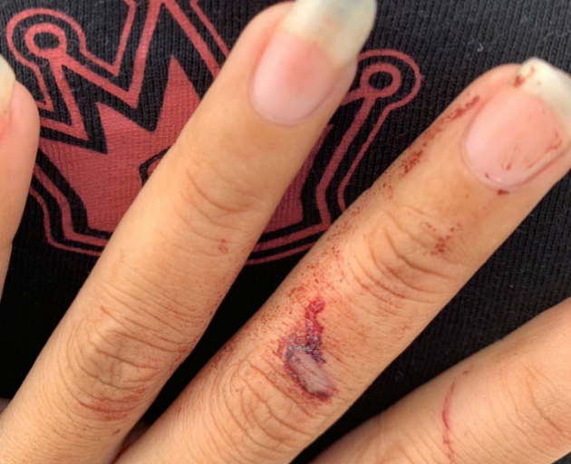 Yuliana Desta's bloodied fingers after an alleged incident with Kelleher in Bali.