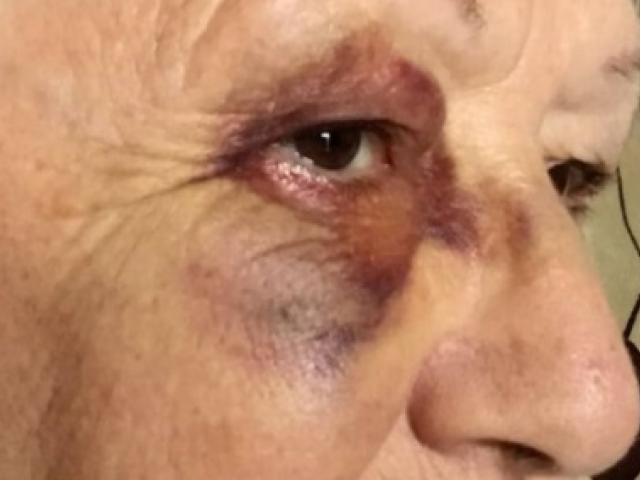 A 72-year-old woman bashed at the Posie Parker rally at Auckland's Albert Park was happy to hear...