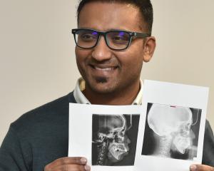 University of Otago oral sciences senior lecturer Dr Adith Venugopal with before (left) and after...