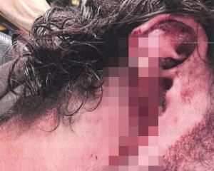 The victim of a central Dunedin assault needed 10 stitches to his ear but the lobe could not be...