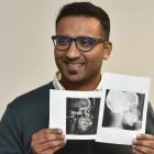 University of Otago oral sciences senior lecturer Dr Adith Venugopal with before (left) and after...