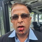 Rajnish Trehan had to receive stitches and will need dental work after being attacked by a...