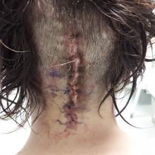 Keri-Lee Turner-Sooalo shows a scar on the back of her head, in the intensive care unit in...